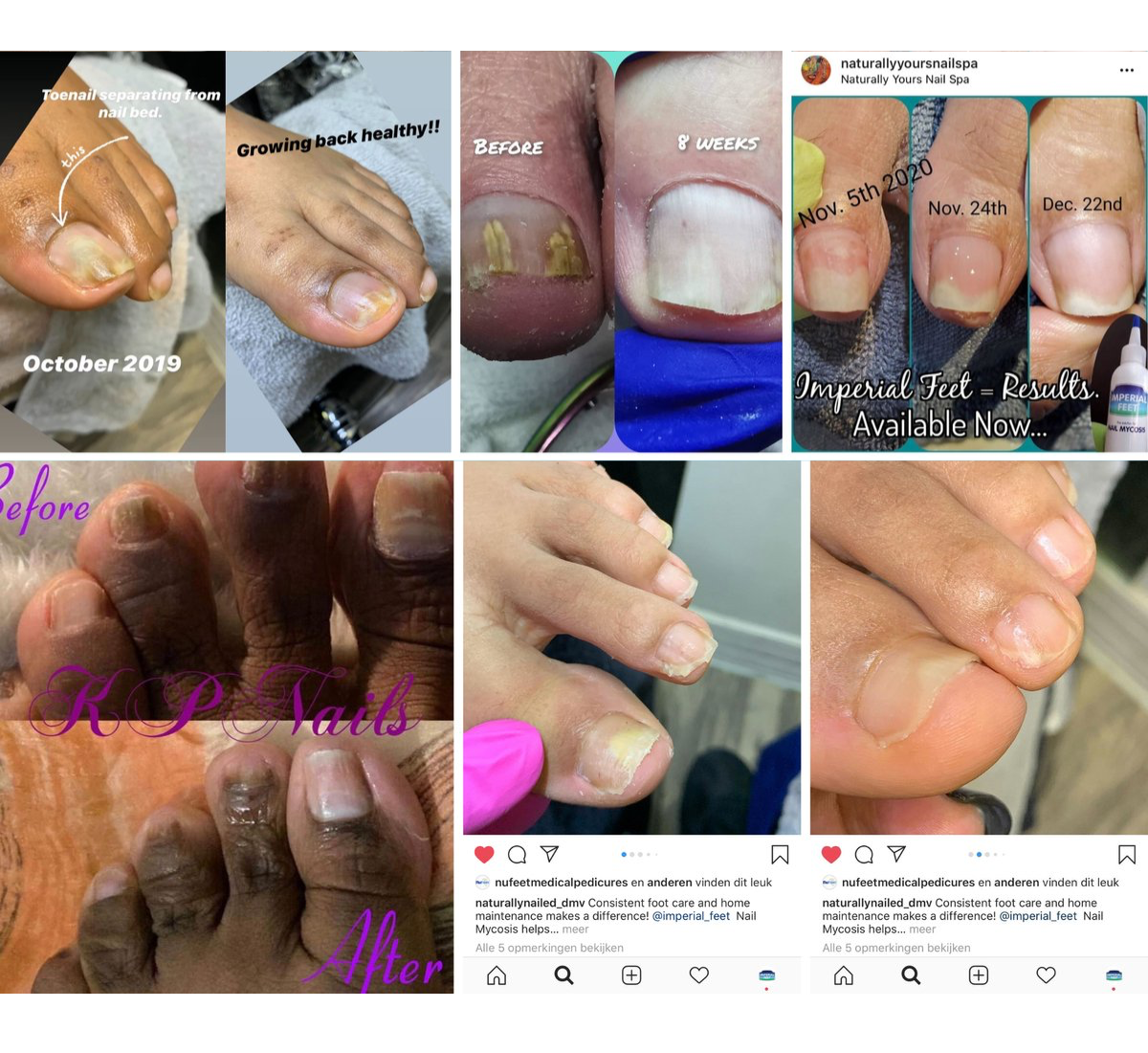 Nail solutions before and after