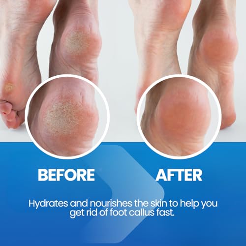 Before and after results of using Imperial Feet products for removing foot callus and hydrating dry skin.