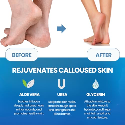 Before and after results of callused skin treated with aloe vera, urea, and glycerin from Imperial Feet products