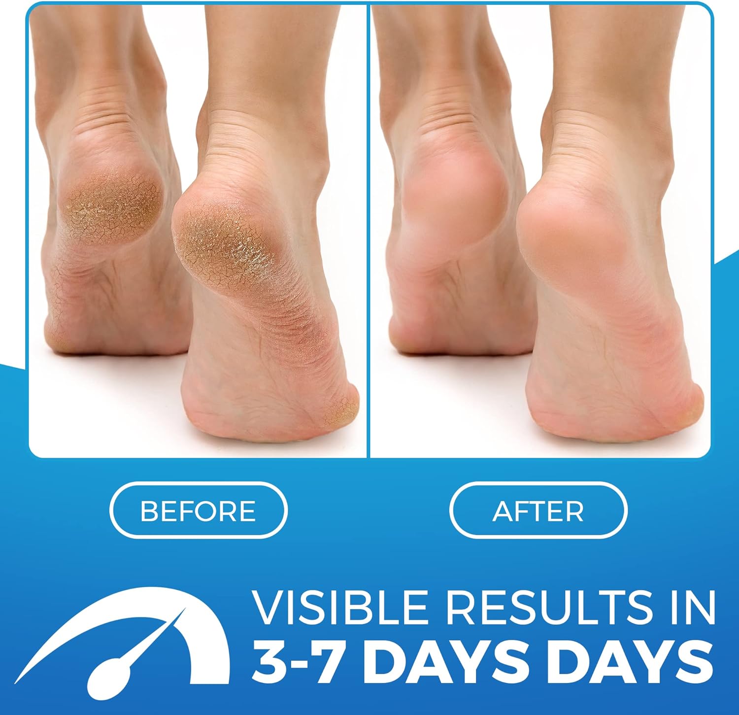 Before and after results showing smoother heels with visible improvement in 3 to 7 days using Imperial Feet products.