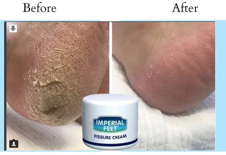 Before and after image showing cracked heel treatment results using Imperial Feet Fissure Cream for dry, damaged skin.