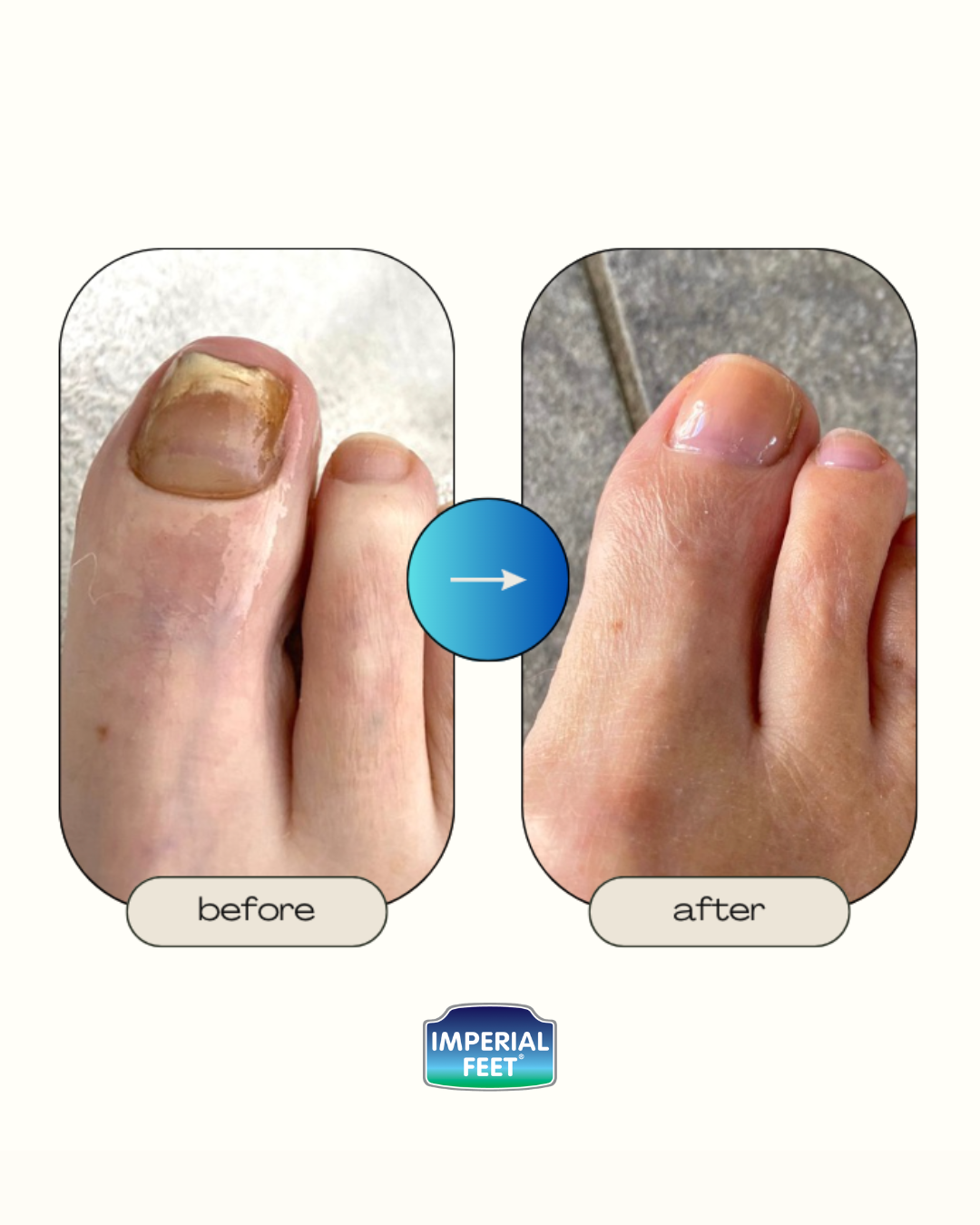 Nail Mycosis Solution