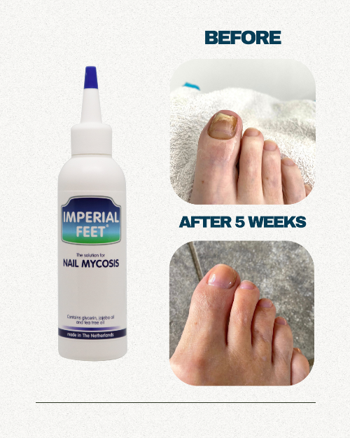 Nail Mycosis Solution
