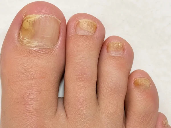 Stage 6: Spreading to other toes