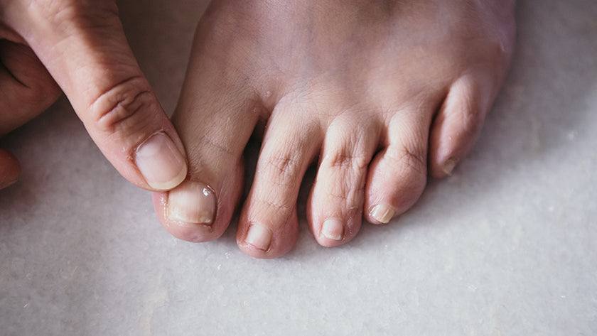 Why is nail fungus so hard to get rid of?