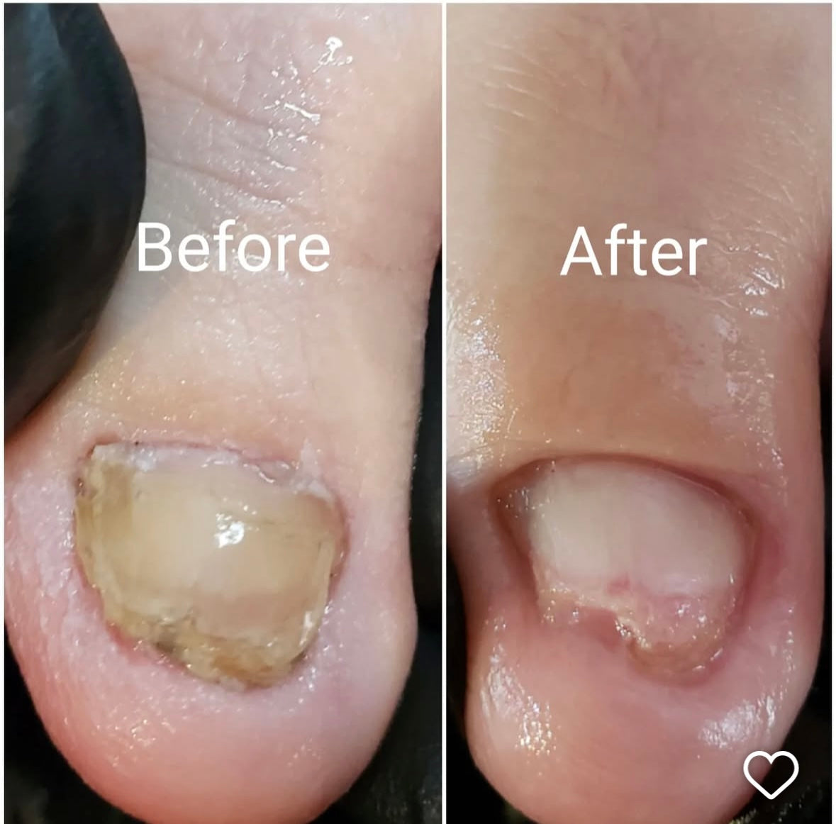 Fungal Nails and Damaged Nails