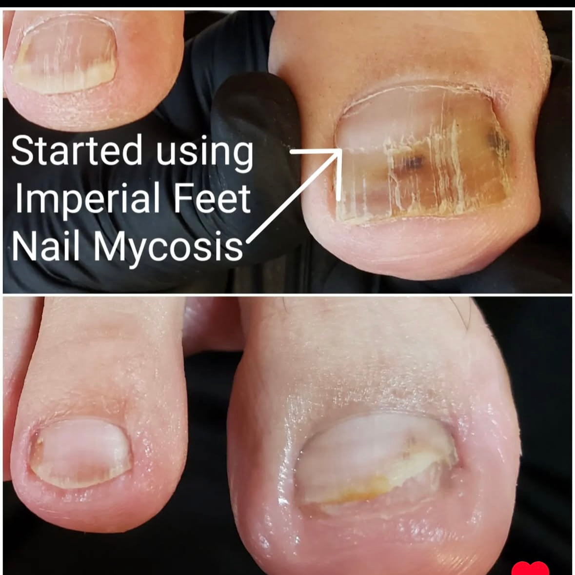 Dr Scholl Fungal Nail Alternative: Imperial Feet Toe Fungus Treatment Compared