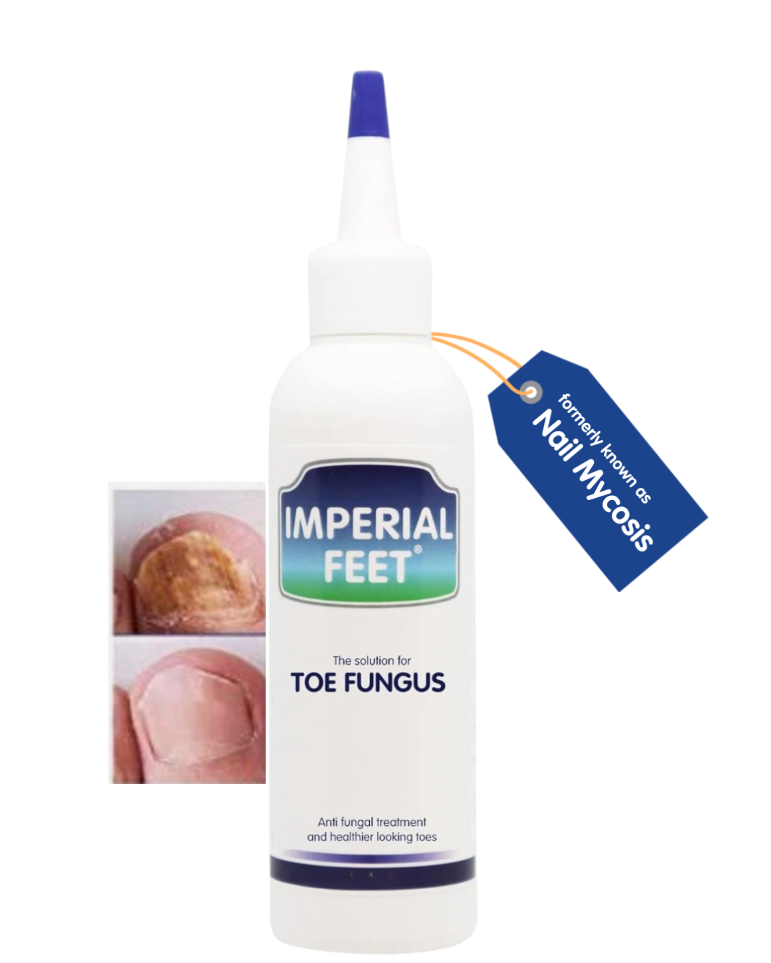 Toenail Fungus Treatments Compared | Ingredients, Application Methods & Options