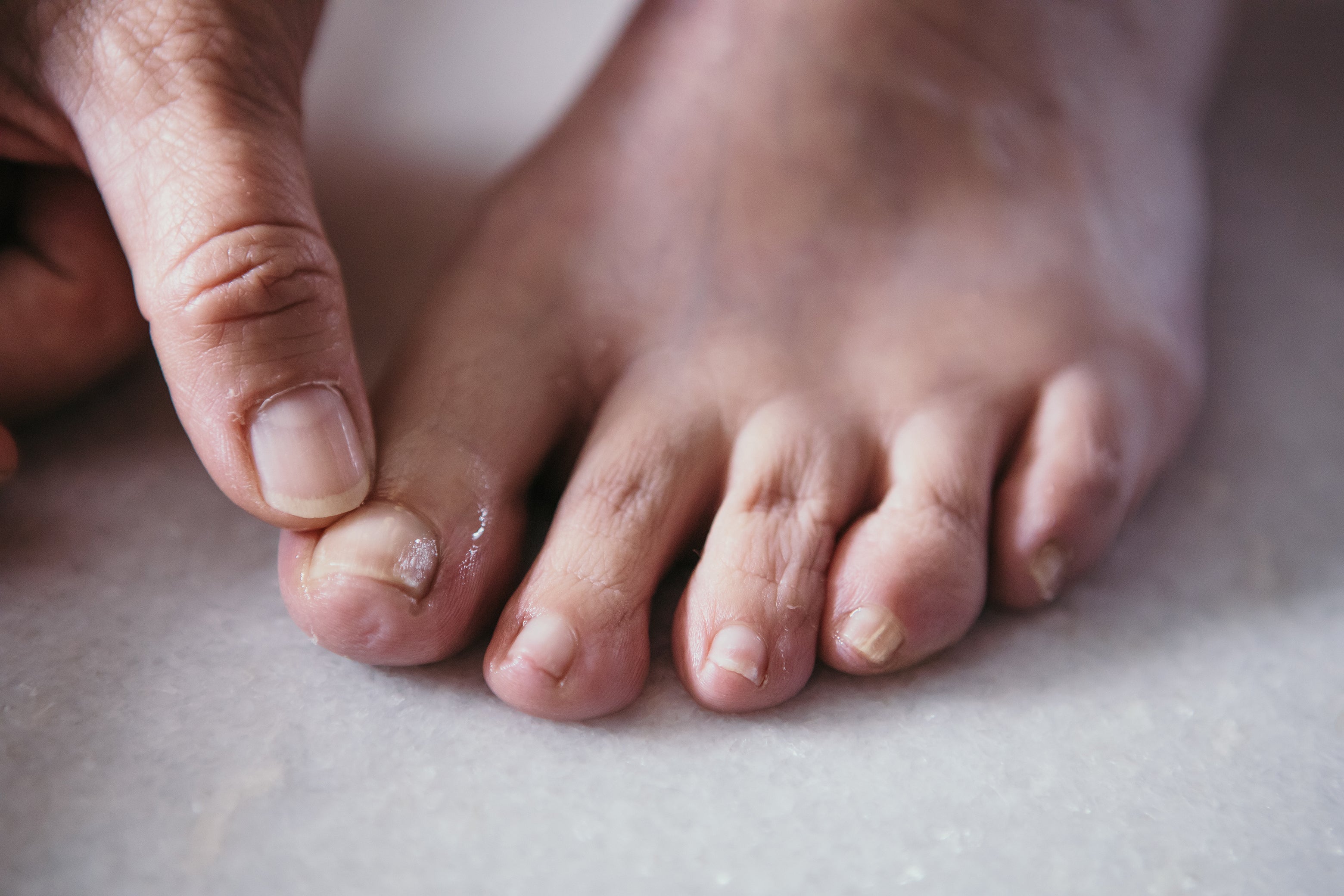 fungal nails