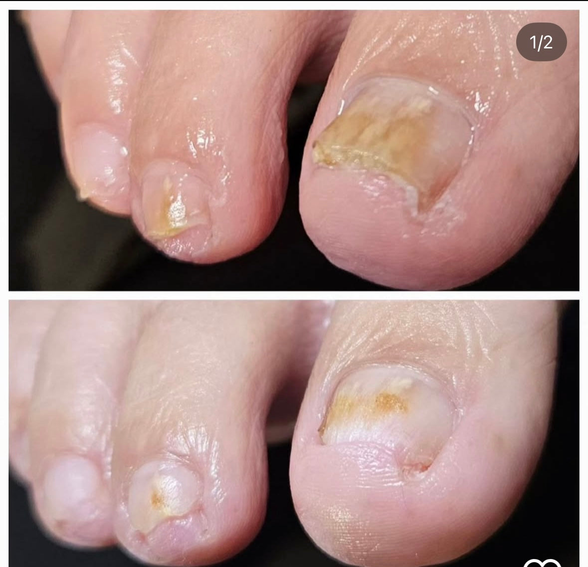 nail mycosis effects and results