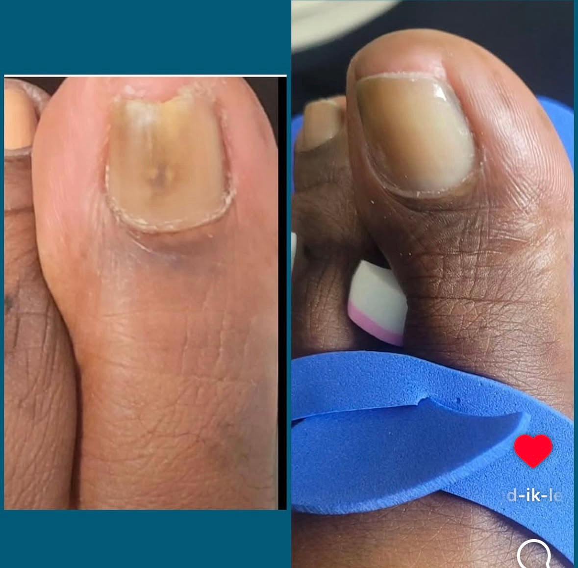 nail mycosis results