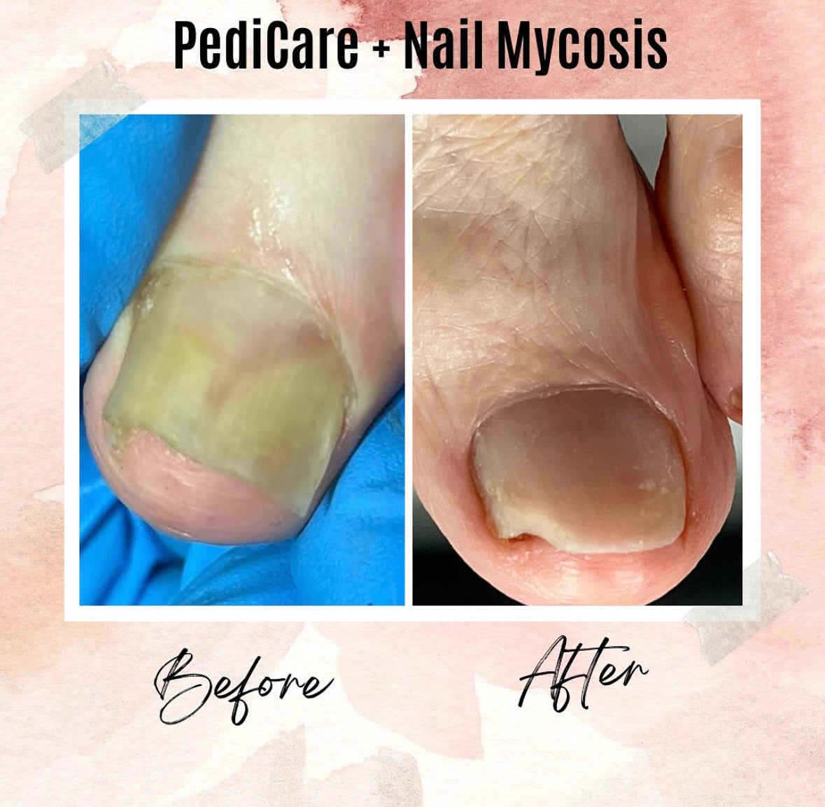 nail mycosis results before and after