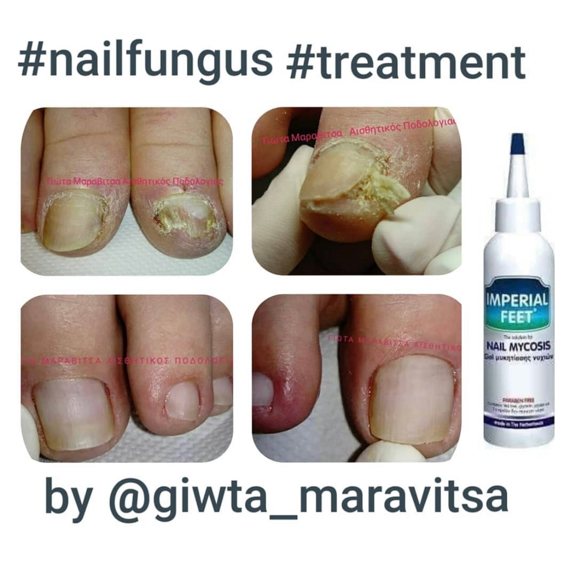 nail fungus treatment