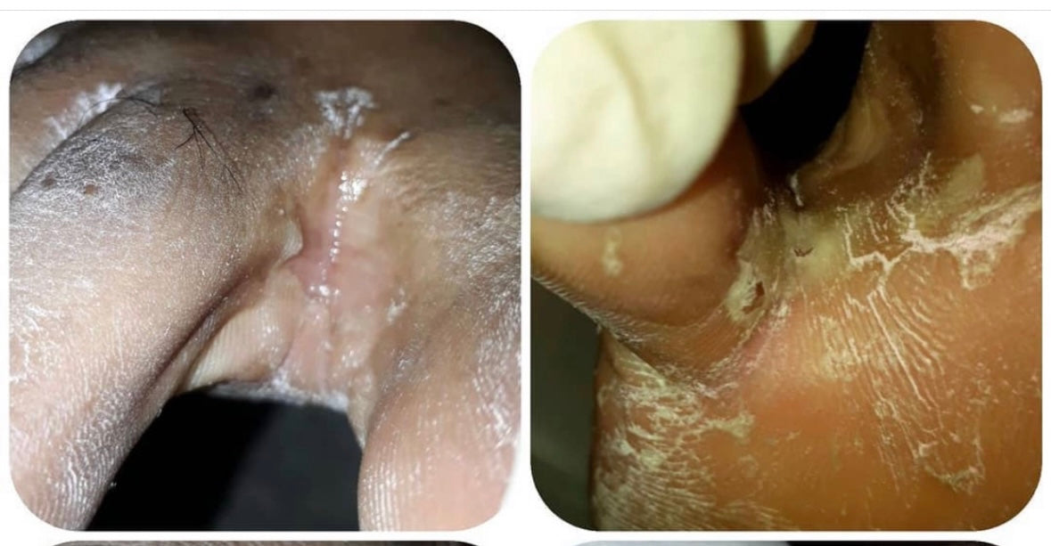 Athlete's Foot Solution