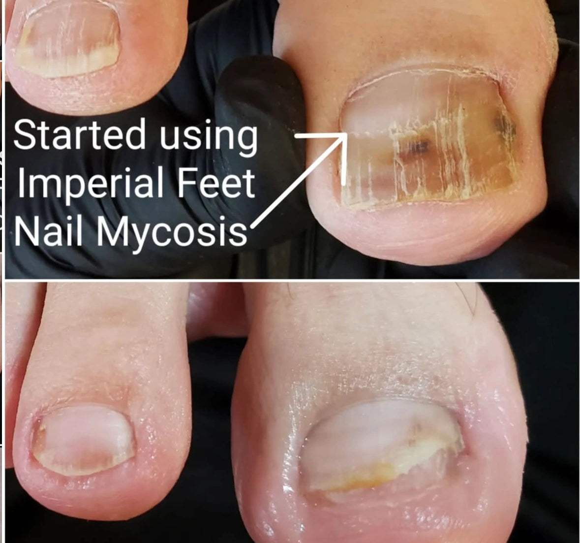 Complete Nail Mycosis Care Kit — Full Treatment System