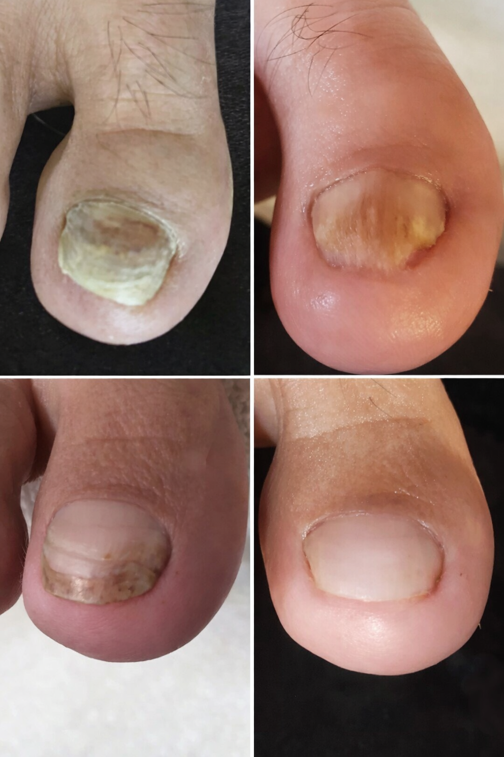 nail fungus before and after treatment