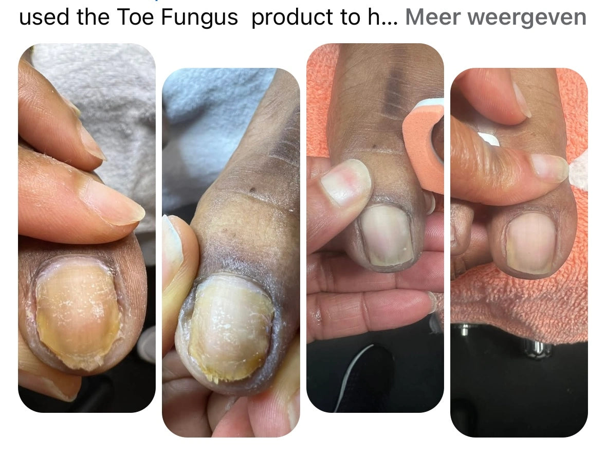 Complete Nail Mycosis Care Kit — Full Treatment System