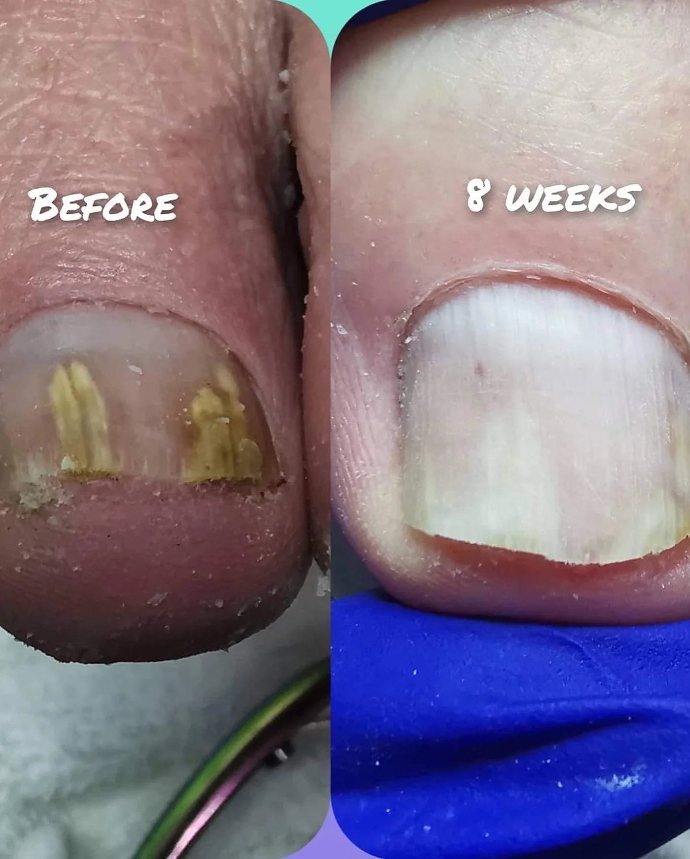 Nail Mycosis Solution