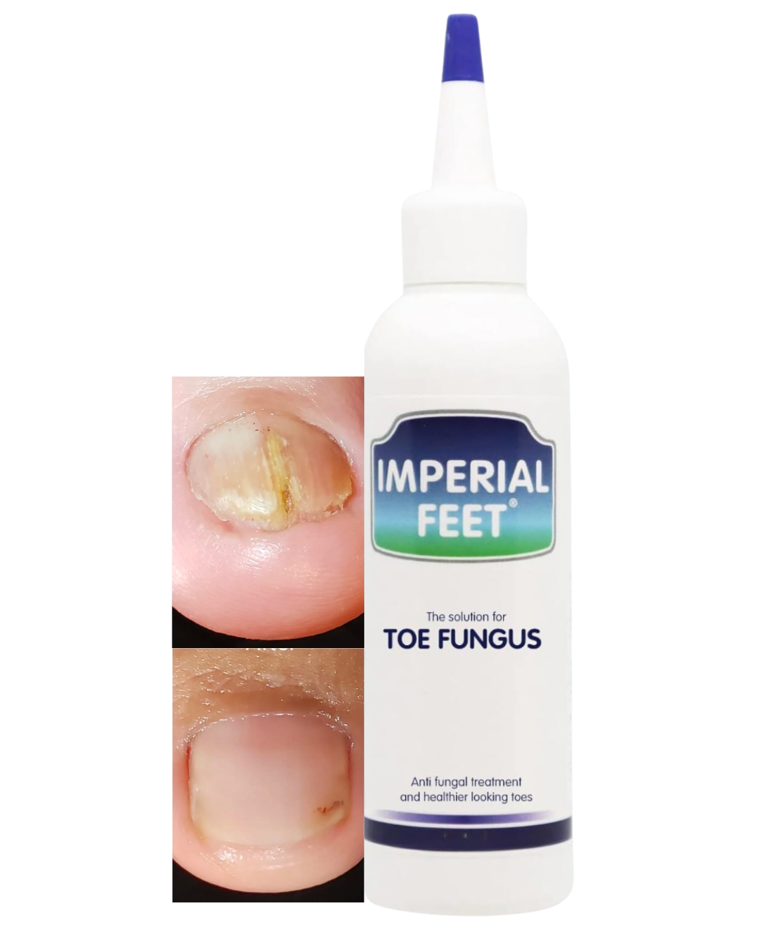 toe fungus