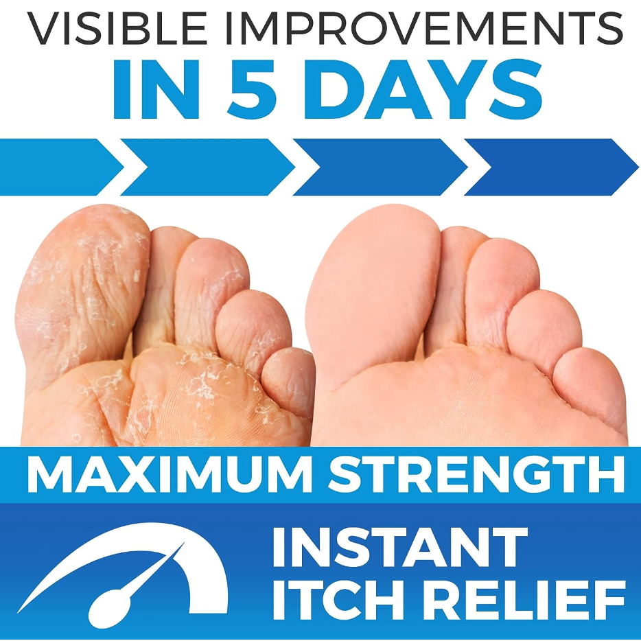 Before and after image of feet showing visible improvement in skin condition within 5 days using maximum strength antifungal treatment for instant itch relief.