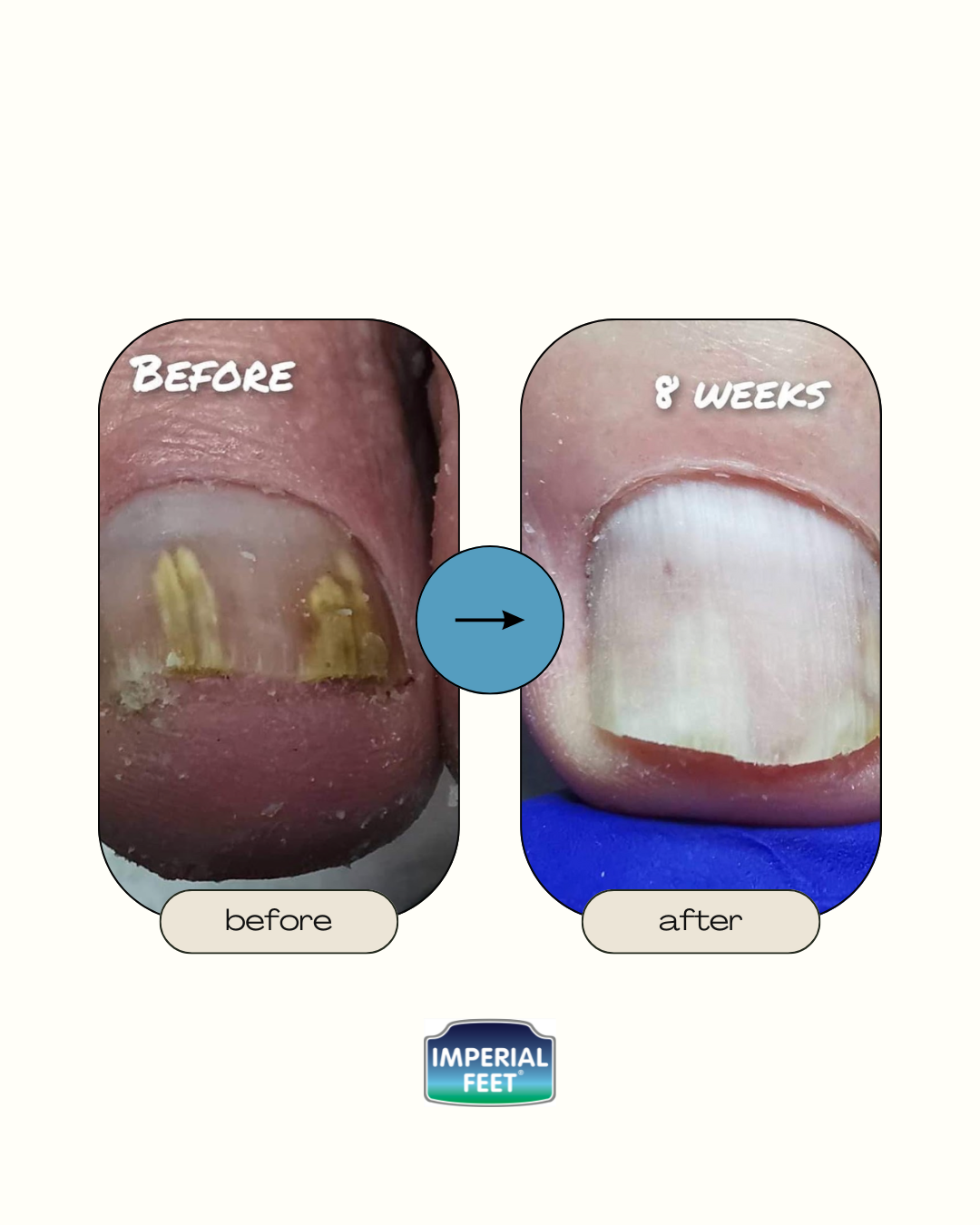 Toe Fungus Solution
