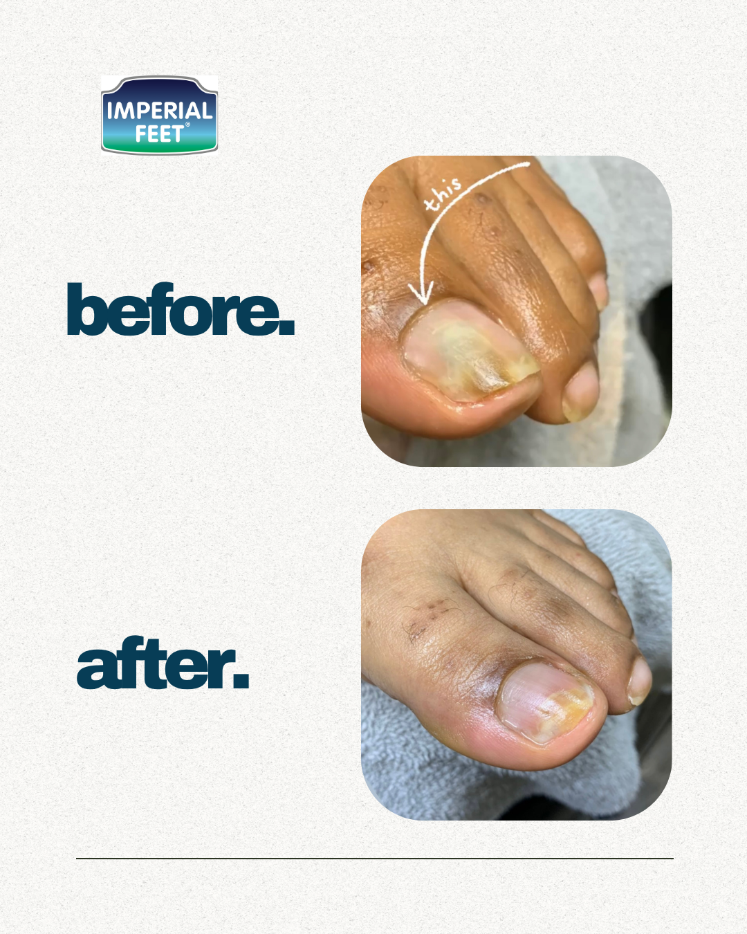 Toe Fungus Solution