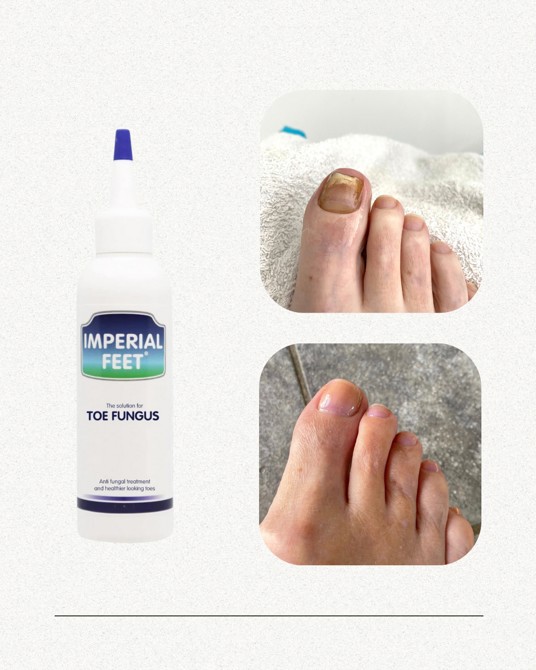 Toe Fungus Solution | Nail Mycosis Solution