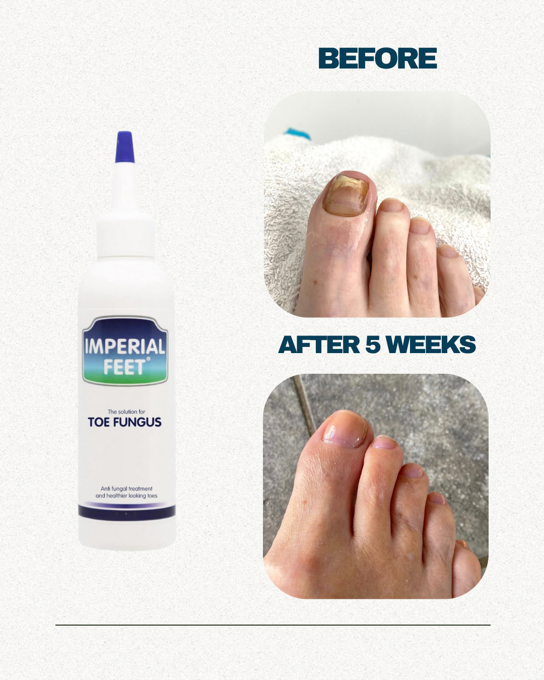 Toe Fungus Solution | Nail Mycosis Solution