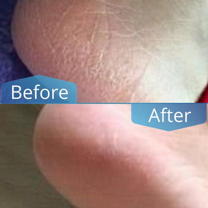 Imperial Feet Athlete's Foot Solution