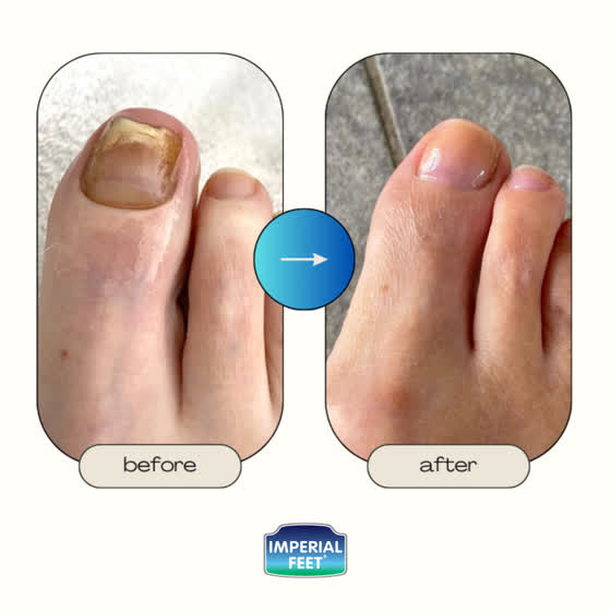 Before and after: yellowed nail to clear nail