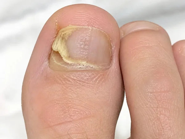 Stage 5: Lifting nail